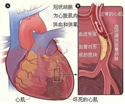 最新血管堵塞治疗方法的研究进展及成果概述