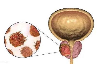 膀胱肿瘤最新治疗方法概述