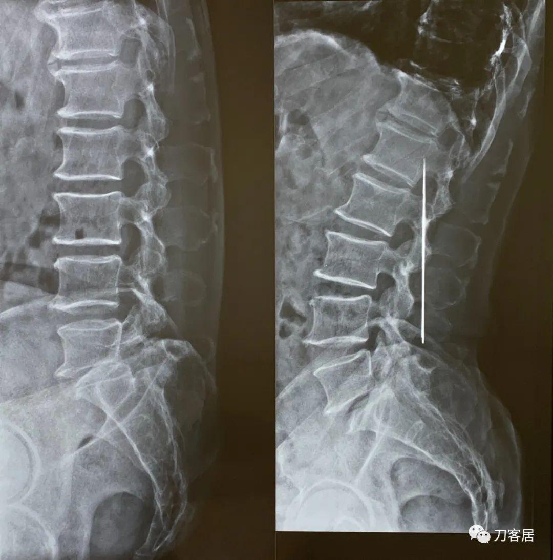 骶管囊肿最新治疗方法